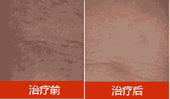 [Ƥ������]���� 35��-lni