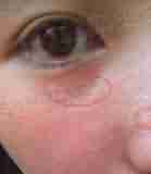 ���󼤹�+��ҽ������Ĥ-lni