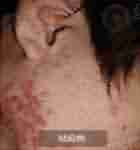 7天祛痘 15天除印-lni