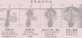 7天祛痘 15天除印-lni