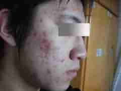 “微晶磨皮”祛痘印,快速彻底-lni