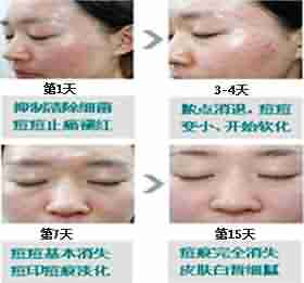 北大采用“中西医结合疗法”-lni