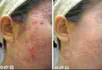 10个痘友7个选择 兰州北大皮肤病专科-lni