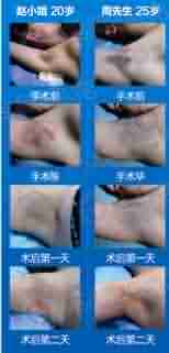 北大腋臭医生揭秘-lni