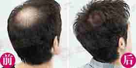 医生在线评估 兰州治疗斑秃的费用-lni