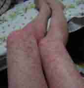 ����ҽ����Ƚ���Ƥ������֢״-lni