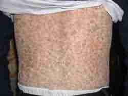 正规医生详解鱼鳞病的症状-lni