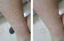 治疗鱼鳞病首选兰州北大皮肤病专科-lni