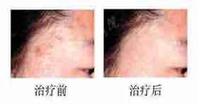 【病因】了解扁平疣病因 针对治疗疾病-lni