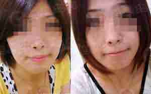 Q色素激光结合中药御方倒膜-lni