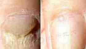 "汉方渗透软化杀菌疗法"-lni