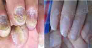 "汉方渗透软化杀菌疗法"-lni