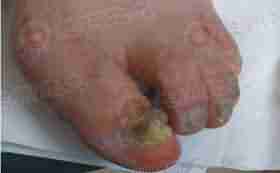 警惕!别让你的家人和你一起染上灰指甲-lni