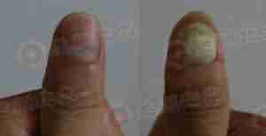 警惕!别让你的家人和你一起染上灰指甲-lni