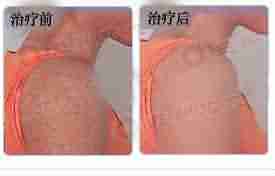 鸡皮肤治疗费用?-lni