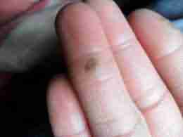 【治疗】寻常疣怎么治 北大专科帮你忙-lni