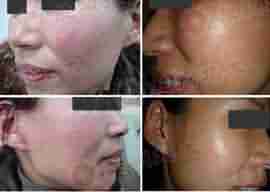 【皮炎】中西医活化脱敏疗法-lni