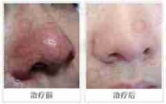 治疗酒糟鼻多少钱?-lni
