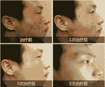 ����������ε���-lni