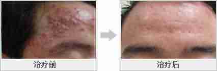 汉方光子清痘平衡疗法-lni