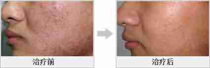 汉方光子清痘平衡疗法-lni