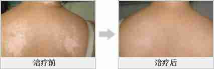 【危害】白癜风危害大-lni