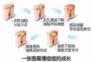 北大专利祛痘 7天祛痘 15天除印美观-lni