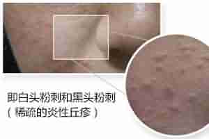 北大专利祛痘 7天祛痘 15天除印美观-lni