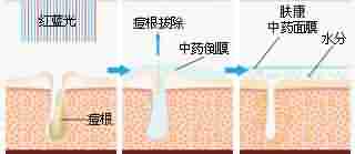 北大专利祛痘 7天祛痘 15天除印美观-lni