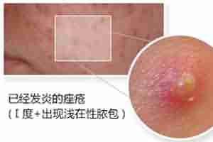 北大专利祛痘 7天祛痘 15天除印美观-lni