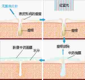北大专利祛痘 7天祛痘 15天除印美观-lni