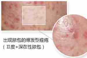 北大专利祛痘 7天祛痘 15天除印美观-lni