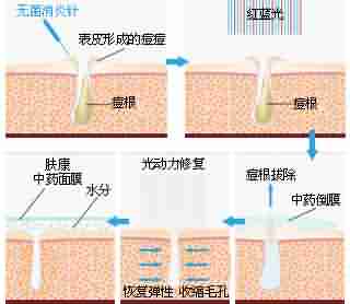 北大专利祛痘 7天祛痘 15天除印美观-lni
