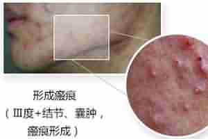 北大专利祛痘 7天祛痘 15天除印美观-lni