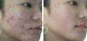 北大专利祛痘 7天祛痘 15天除印美观-lni