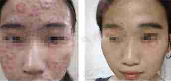 北大专利祛痘 7天祛痘 15天除印美观-lni