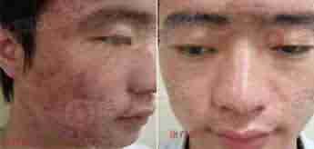 北大专利祛痘 7天祛痘 15天除印美观-lni