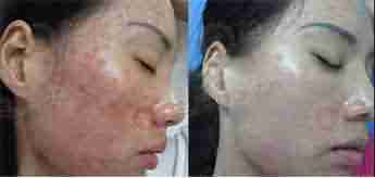 北大专利祛痘 7天祛痘 15天除印美观-lni