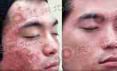 北大专利祛痘 7天祛痘 15天除印美观-lni