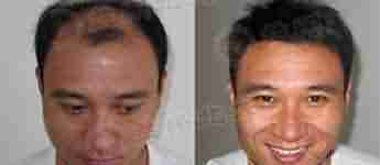 ���Ҽ������ѷ� ����ë�Ҽ��������Ʒ�-lni