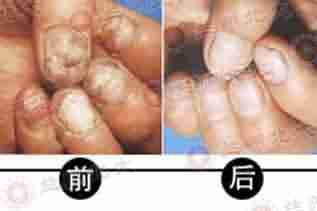 汉方渗透软化杀菌疗法20天根除灰指甲不复发-lni