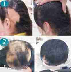 兰州北大治疗斑秃更专业-lni