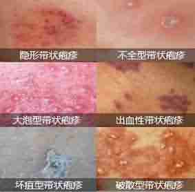 【症状】带状疱疹有哪些分类及症状-lni