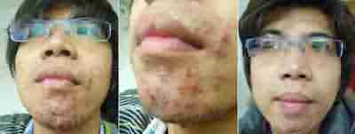 北大倡导科学祛痘 让青春不再有“痘”留-lni