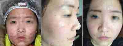 北大倡导科学祛痘 让青春不再有“痘”留-lni