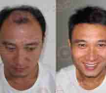 北大医生解读斑秃的三大症状-lni