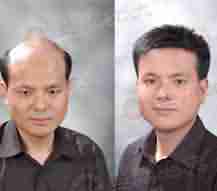 北大医生解读斑秃的三大症状-lni