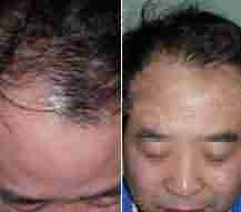 北大医生解读斑秃的三大症状-lni