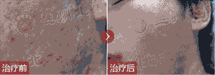 中西结合治疗痘坑痘印效果好-lni