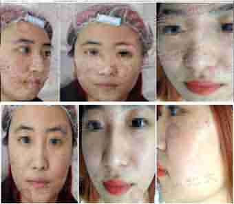 痘友一句666,北大皮肤科主任懵了-lni